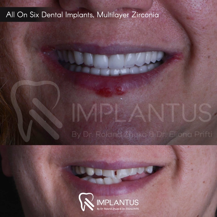 allonsix-dental-implants-multilayer-zirconia-3