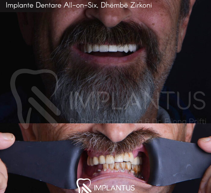 Implante Dentare