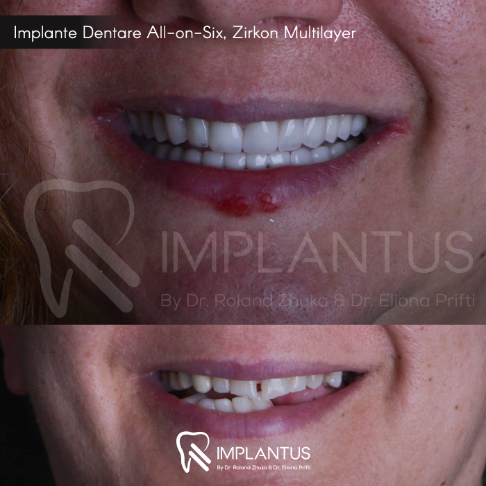 implante-dentare-allonsix-zirkon-multilayer-3