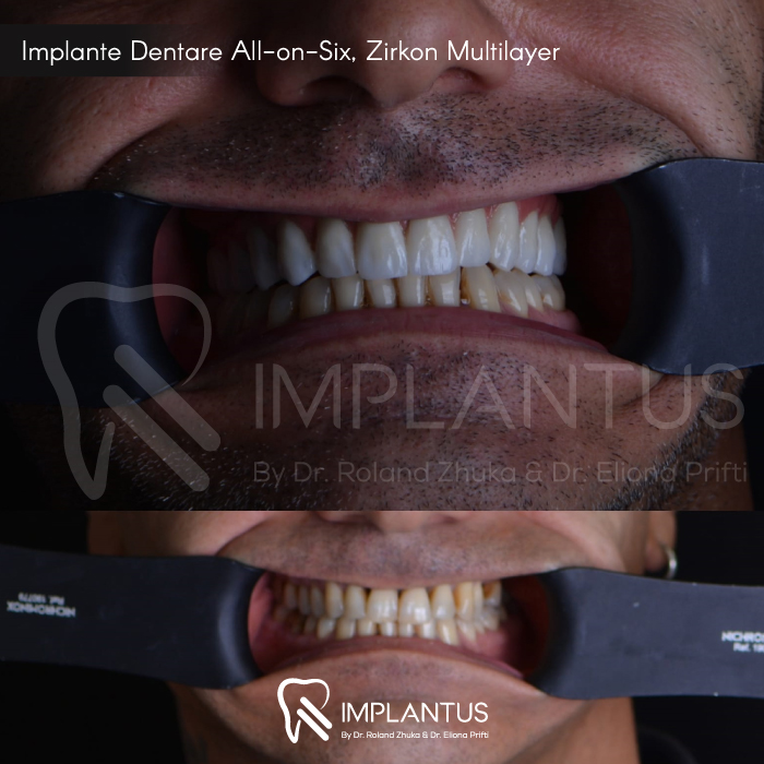 implante-dentare-allonsix-zirkon-multilayer-4