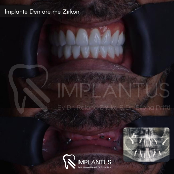 implante-dentare-zirkon