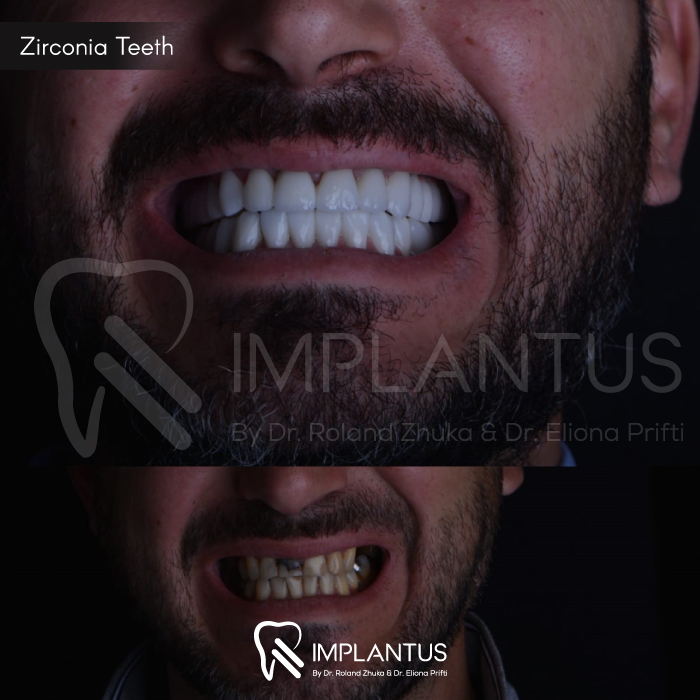 zirconia-teeth-1