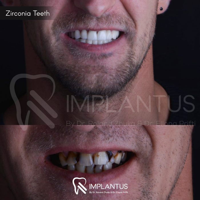 zirconia-teeth-10
