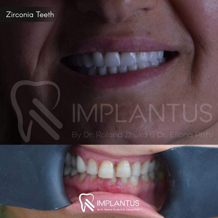zirconia-teeth-2
