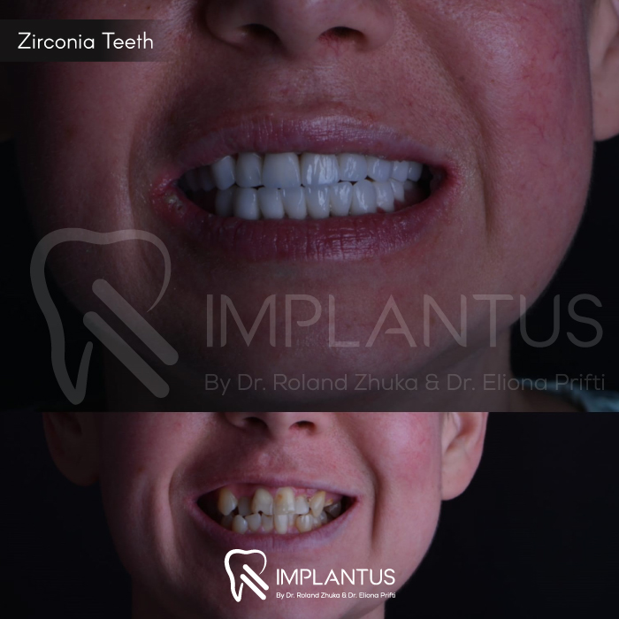 zirconia-teeth-3