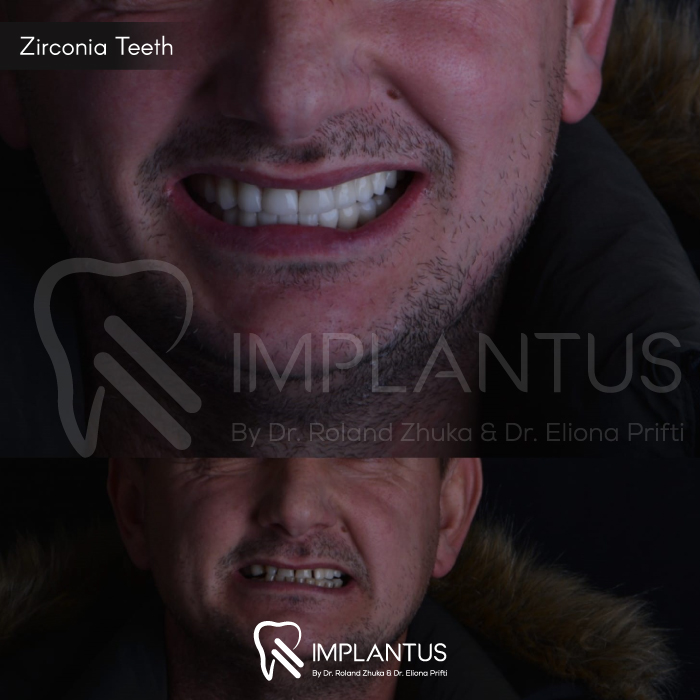 zirconia-teeth-6