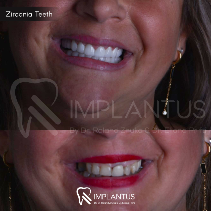 zirconia-teeth-7