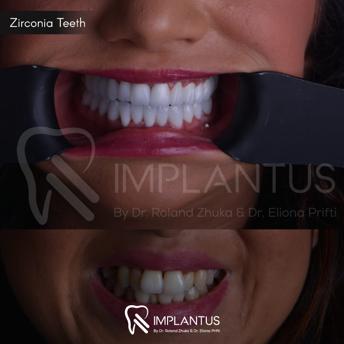 zirconia-teeth-8