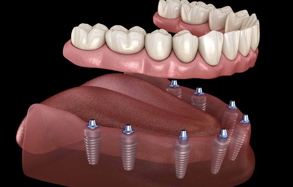 Considerations when Choosing the Best Dental Clinic in Albania for Dental Implants