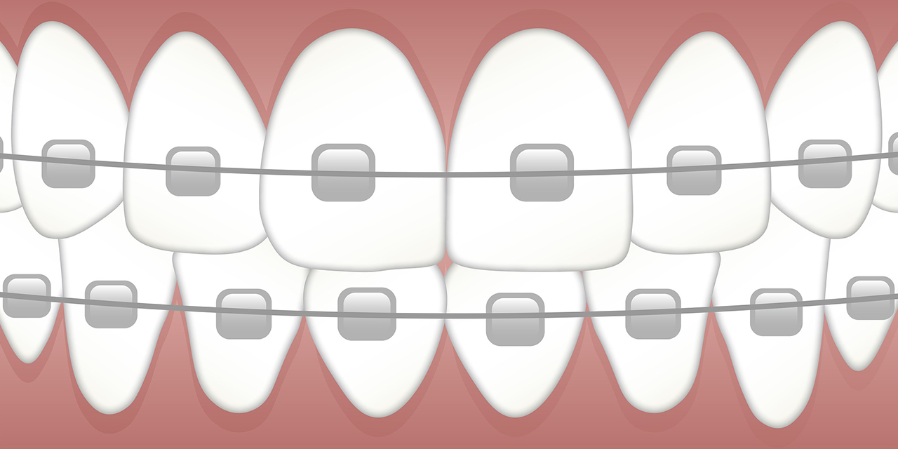Exploring the Process of Getting Traditional Braces and Invisalign