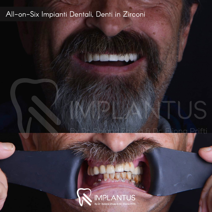 All-on-Six-Impianti-Dentali,-Denti-in-Zirconi--1