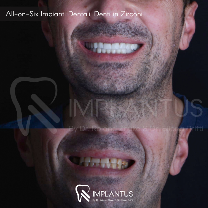 All-on-Six-Impianti-Dentali,-Denti-in-Zirconi--2