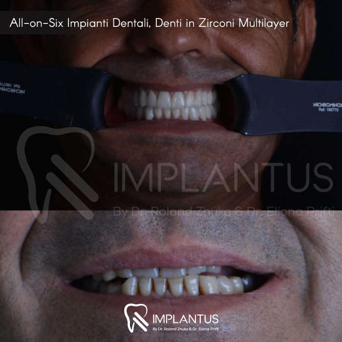 All-on-Six-Impianti-Dentali,-Denti-in-Zirconi-Multilayer--1