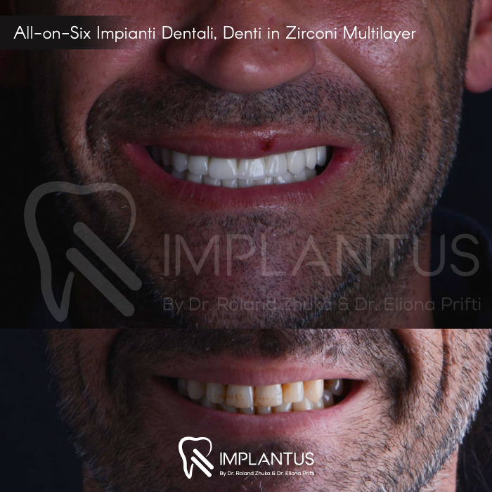 All-on-Six-Impianti-Dentali,-Denti-in-Zirconi-Multilayer--2