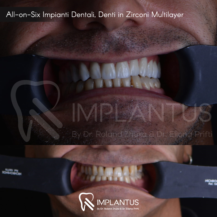 All-on-Six-Impianti-Dentali,-Denti-in-Zirconi-Multilayer--4