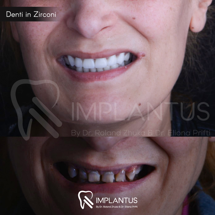Denti-in-Zirconi--4