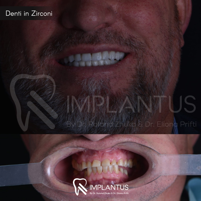 Denti-in-Zirconi--5