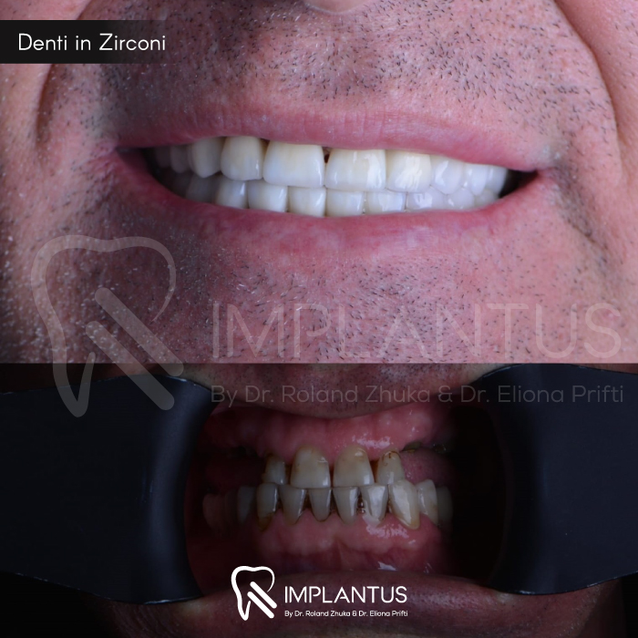Denti-in-Zirconi--9
