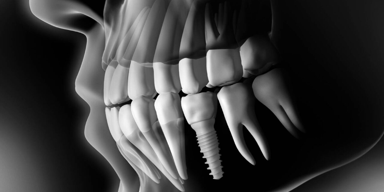 A Guide To Finding The Right Type Of Dental Implant For You