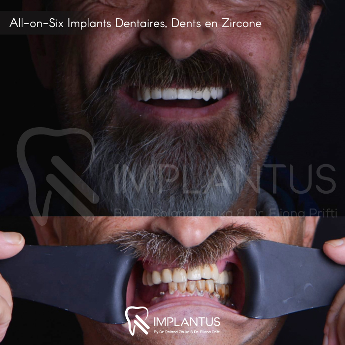 All-on-Six-Implants-Dentaires,-Dents-en-Zircone-1