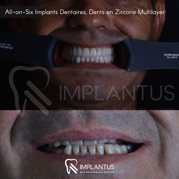 All-on-Six-Implants-Dentaires,-Dents-en-Zircone-Multilayer-1