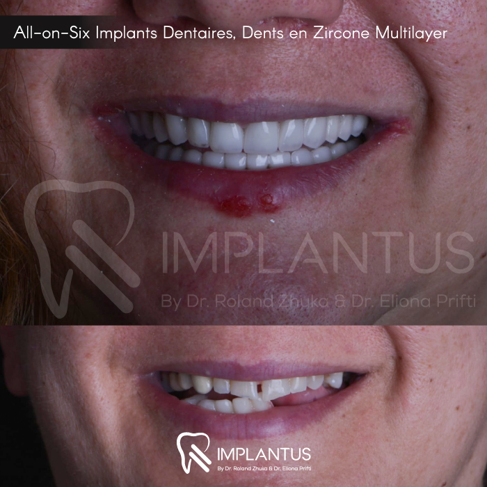 All-on-Six-Implants-Dentaires,-Dents-en-Zircone-Multilayer-3