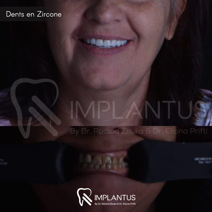 Dents-en-Zircone-1
