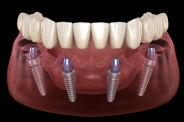 dental implants albania